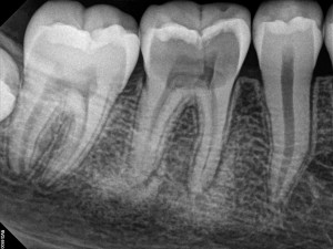 gross decayed tooth.