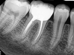 after the root canal has been completed on the tooth.