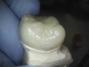 This is a picture of a final crown that will go over the newly treated root canal tooth.