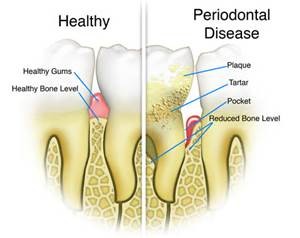 periodontal disease vs healthy gums