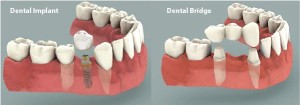 dental implants vs bridge