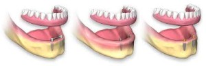 picutre of an over-denture. 