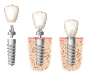 Parts of an implant