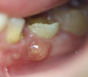 tooth abscess