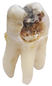 extracted tooth
