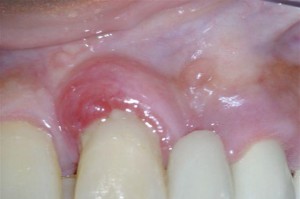 periodontal abscess