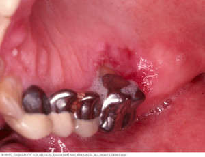 Oral Cancer can take different colors and forms. This picture is also oral cancer in the mouth.
